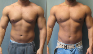 Ciclo de stanozolol e oxandrolona para homens