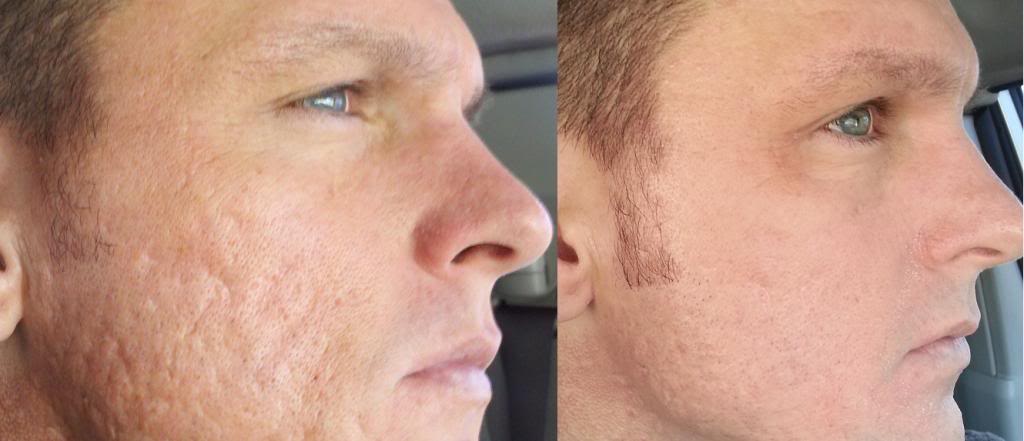 acne scarring tretinoin gel - Dan the Bodybuilder in Thailand